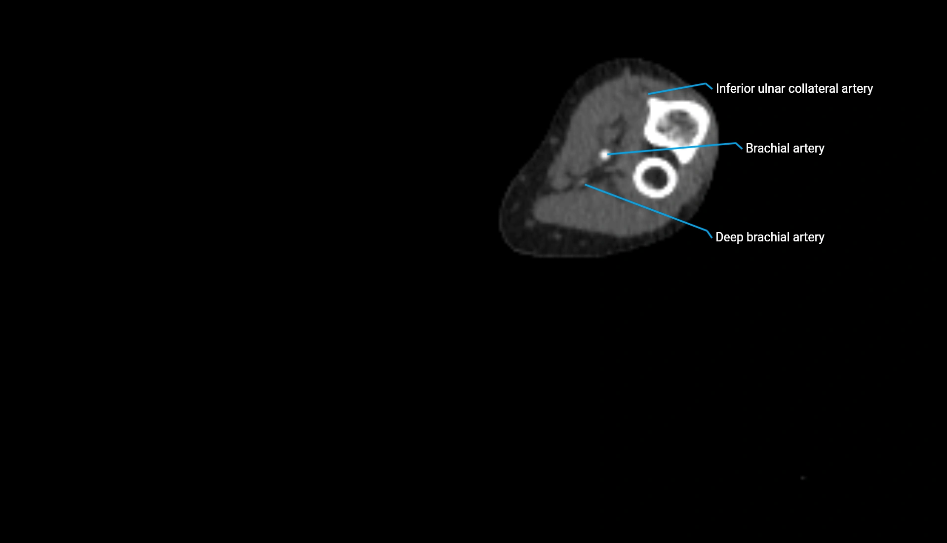 CTA upper limb axial cross sectional anatomy labelled image 178 (2).webp